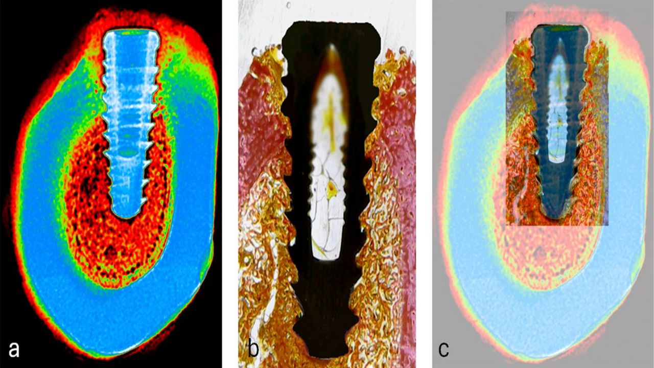 Osseointegration Explained in Plain Language