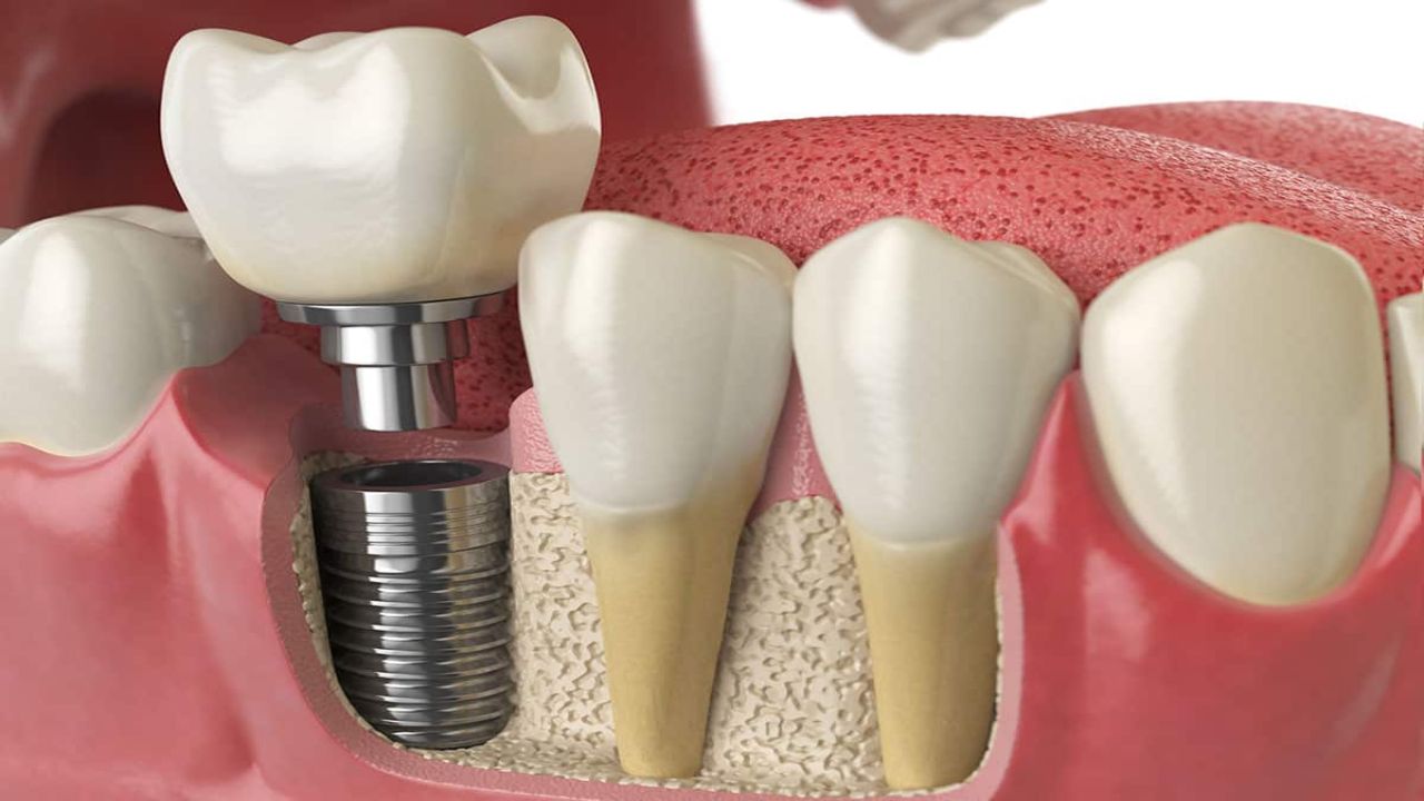 What a Dental Implant Actually is And Why It Feels So Stable